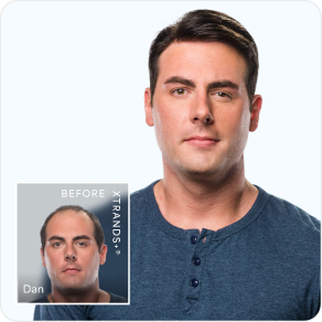 FUE Hair Transplant California